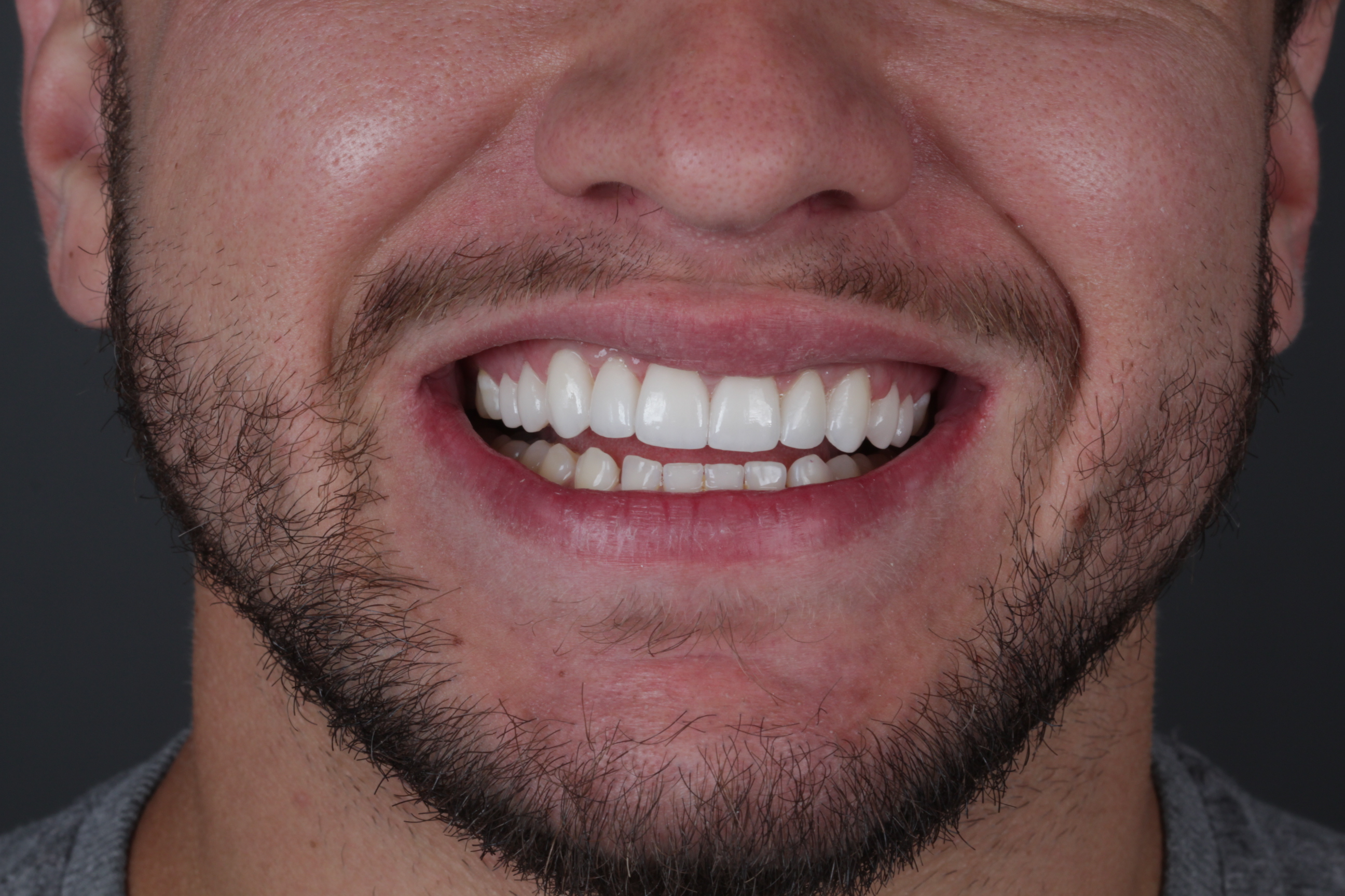 Depois de lentes de contato dental